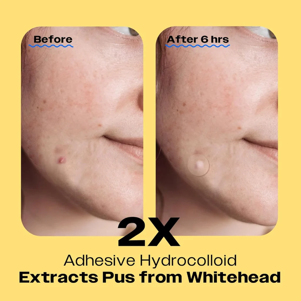 Avarelle pimple patch